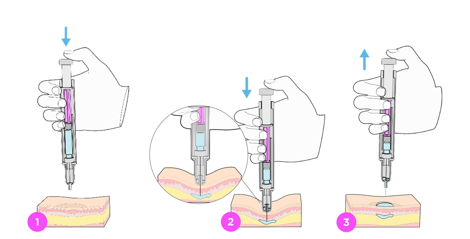 Image: Lift and spray wet injection