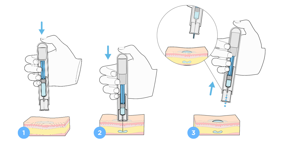 Image: Early release pooling from a wet injection