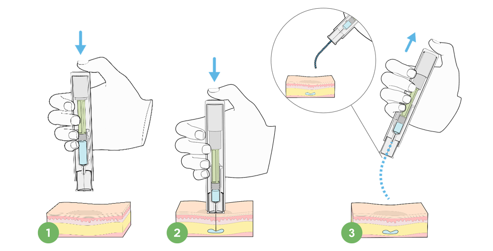 Image: Pooling due to compression causing a wet injection