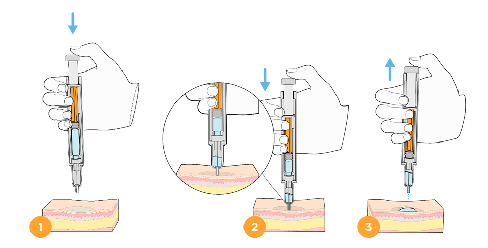 Image: Medication becoming collected in a needle safety device